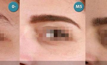 Eyebrow transplantation surgery before and after images
