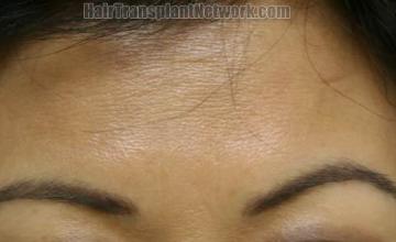 Female eyebrow transplant surgery before and after