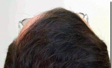 Hair restoration procedure results