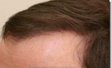 Hair restoration procedure results