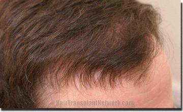 Hair restoration procedure results