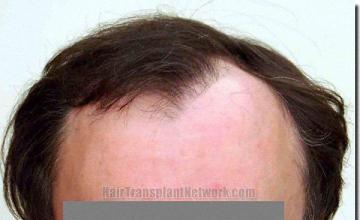 Hair restoration procedure results