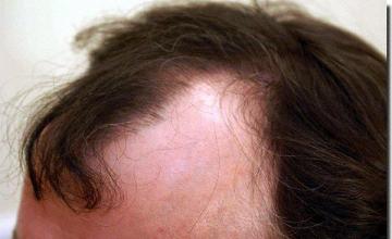 Hair restoration procedure results