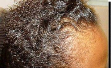 Hair restoration procedure results