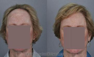 Female hair restoration procedure before and after results