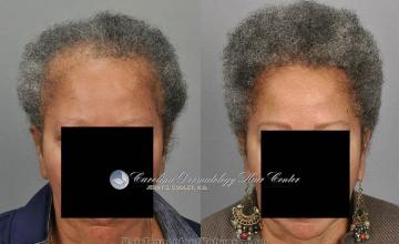 Female before and after