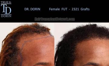 Hair transplantation surgery before and after images