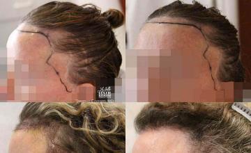 Hair transplantation surgery before and after photos