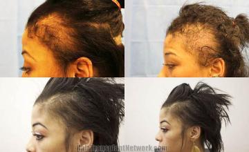 Hair transplantation surgery before and after photos