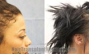 Hair restoration procedure before and after results