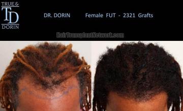 Hair transplantation surgery before and after photos