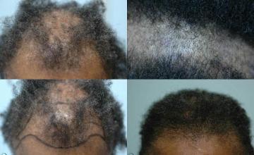 Hair transplantation surgery before and after images