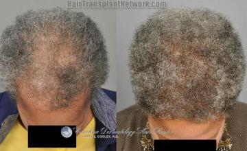 Female hair transplantation surgery before and after images