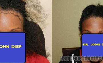 Hair restoration procedure before and after results