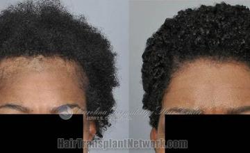 Front view - Before and after