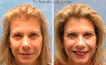 Female before and after photos