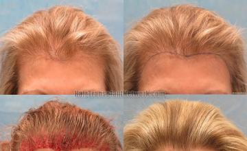 Female hair transplantation procedure before and after result