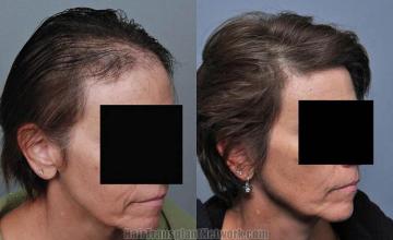 Hair transplantation surgery before and after photos