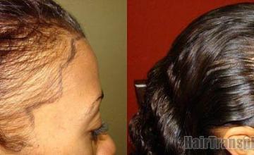 before and after photos