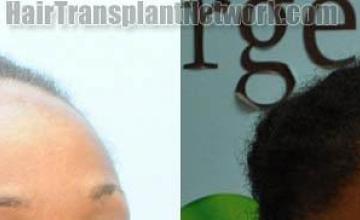  before and after photos