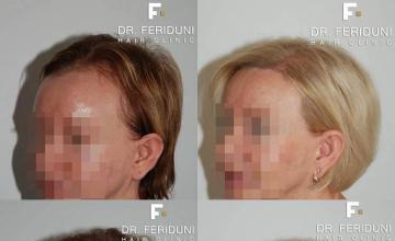 Hair transplantation surgery before and after pictures