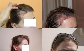 Hair transplantation surgery before and after images