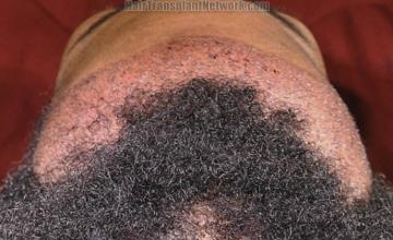 Hair transplant surgery before and after images