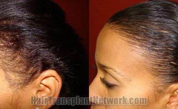  before and after images