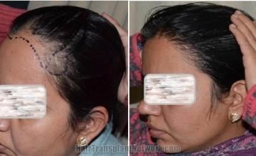 Female hair transplantation surgery before and after images