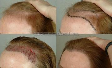 Hair transplantation surgery before and after photos