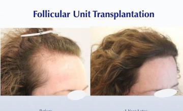 Female hair transplantation procedure before and after result