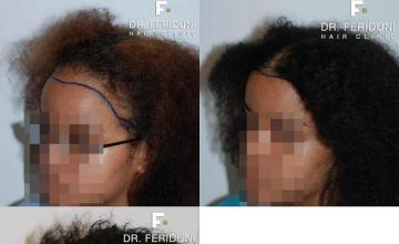 Hair transplant surgery before and after photos