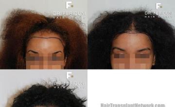 Front view - Before and after hair transplant surgery result images