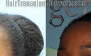 air transplant surgery before and after pictures