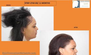 Hair transplantation surgery before and after images