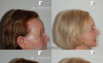 Hair transplantation surgery before and after images