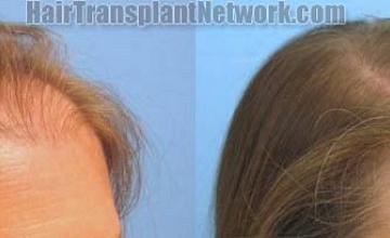 Female hair transplantation surgery before and after images