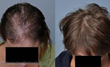 Before and after hair transplant procedure images