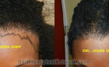 Hair transplantation surgery before and after photos