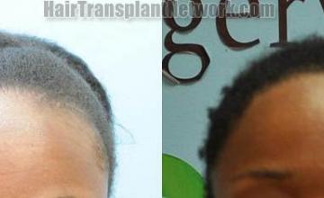 Front view - Before and after  