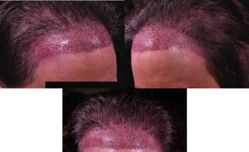 Hair transplantation surgery before and after pictures