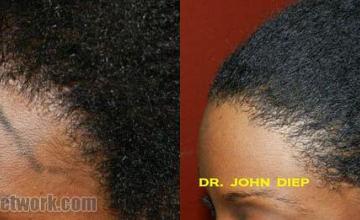 Hair transplantation surgery before and after pictures