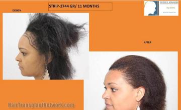 Hair transplantation surgery before and after pictures