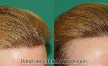 Hair transplantation surgery before and after images