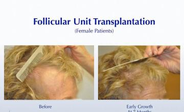 Hair transplantation surgery before and after photos