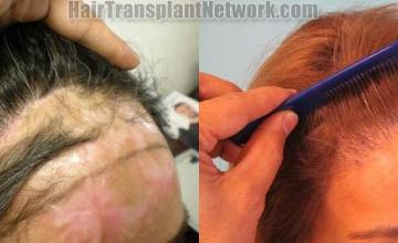 Hair transplantation surgery before and after images