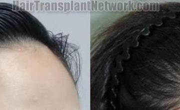 Hair transplantation surgery before and after photos