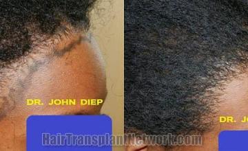 Hair transplantation surgery before and after images