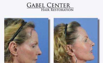 Hair restoration procedure before and after results