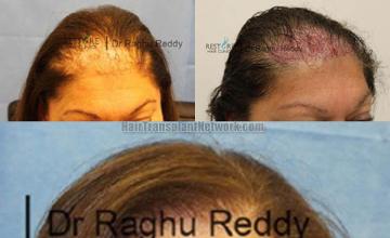 Hair transplantation surgery before and after pictures